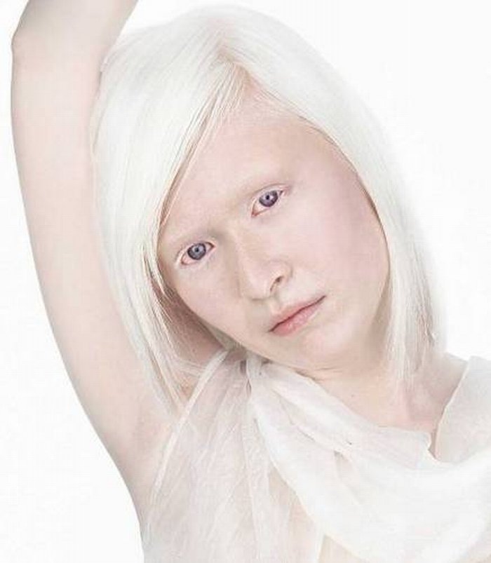 Бескровные люди- альбиносы, Альбиносы с красными глазами, Альбинизм у